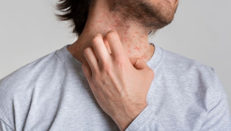 Eczema rimedi cause